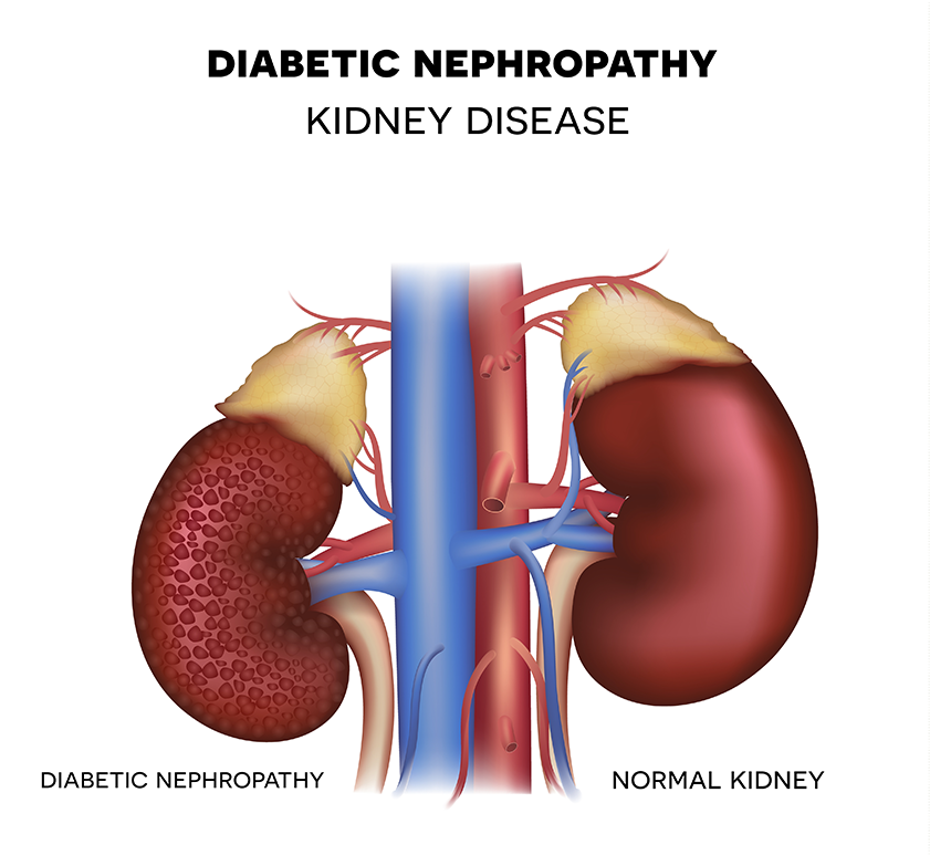 medical illustration of diabetic kidney disease