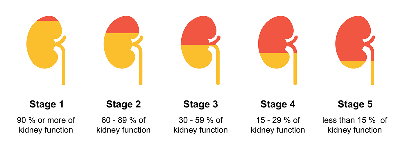 illustration of stages of kidney disease